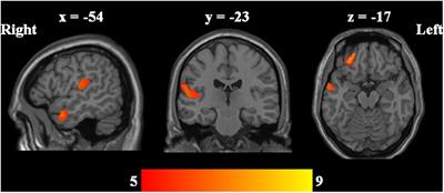 Specific Gray Matter Volume Changes of the Brain in Unipolar and Bipolar Depression